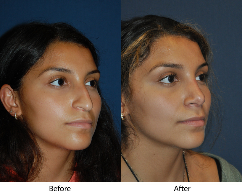 Rhinoplasty Specialist in Charlotte discusses Surgical Optimal Results