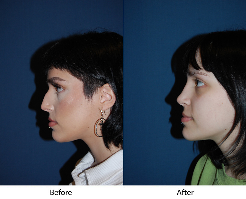 Teen rhinoplasty surgeons in Charlotte NC explains teen nose change over the years