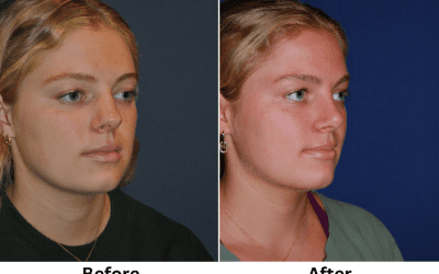 Nose Job Surgeon in Charlotte Discusses Rhinoplasty and Your Health