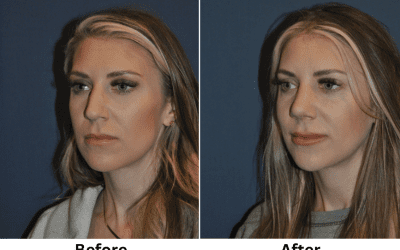 Charlotte’s Rhinoplasty Specialist – What You Need to Know