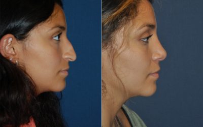 Charlotte’s Top Nose Job Surgeon – Rhinoplasty to Help with Breathing