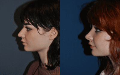 Charlotte’s Rhinoplasty Surgeon: Pain, Risks, and Recovery