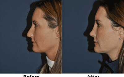 Rhinoplasty Specialist in Charlotte NC Gives Realistic Expectations