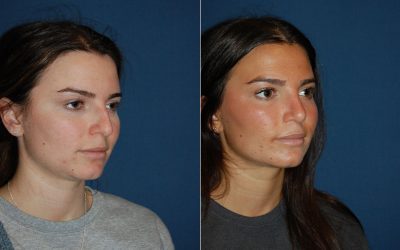 Charlotte’s Top Teen Rhinoplasty Surgeons Helps WIth Informed Decisions