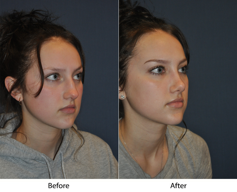Charlotte’s Top Rhinoplasty Recovery Guide