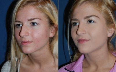 Charlotte’s Best Rhinoplasty Specialist: Facial Asymmetry