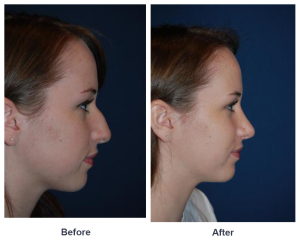 Rhinoplasty