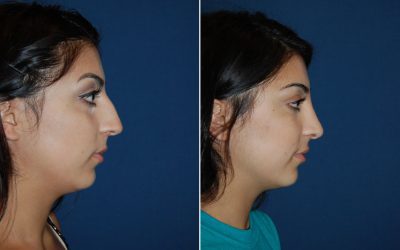 Charlotte’s top teen rhinoplasty surgeons discusses timing